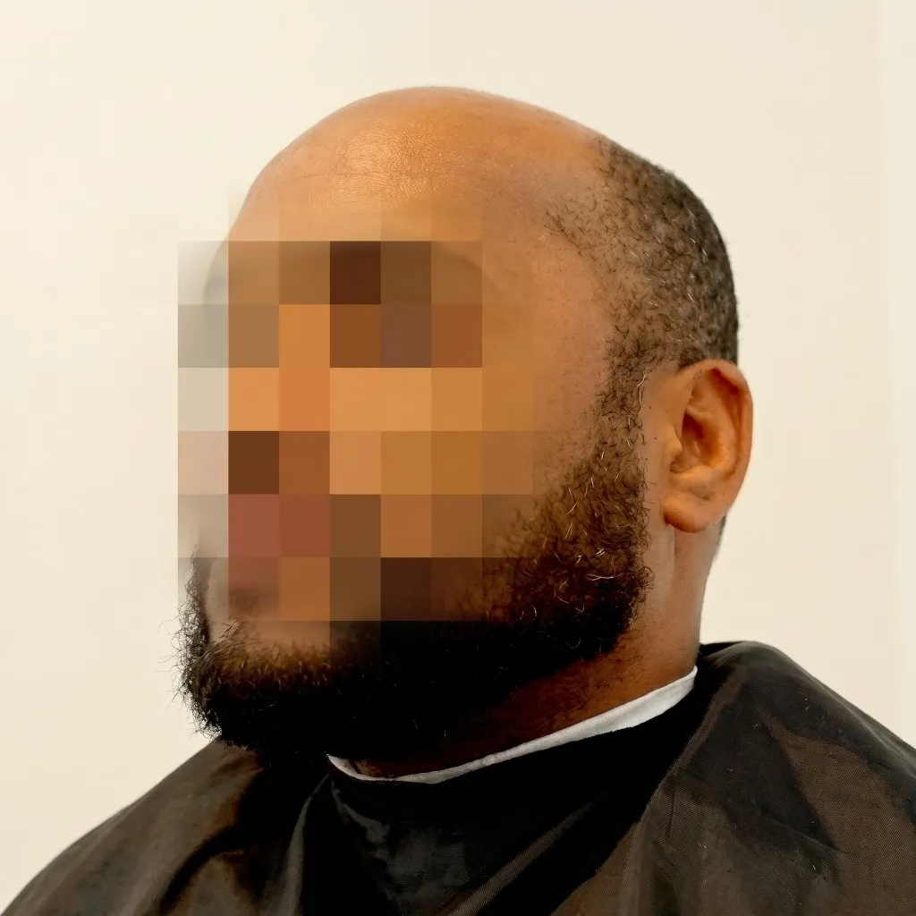 Perfil con la parte superior de la cabeza sin cabello antes del Sistema CTR y con cabello corto y rizado después.