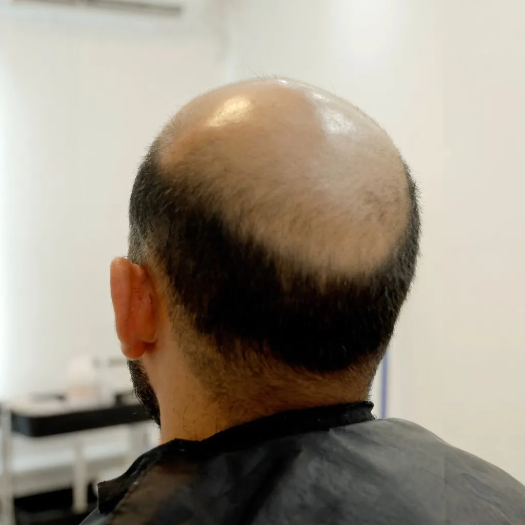Cabeza vista de espaldas, con la coronilla sin cabello antes del Sistema CTR y con cabello oscuro después.