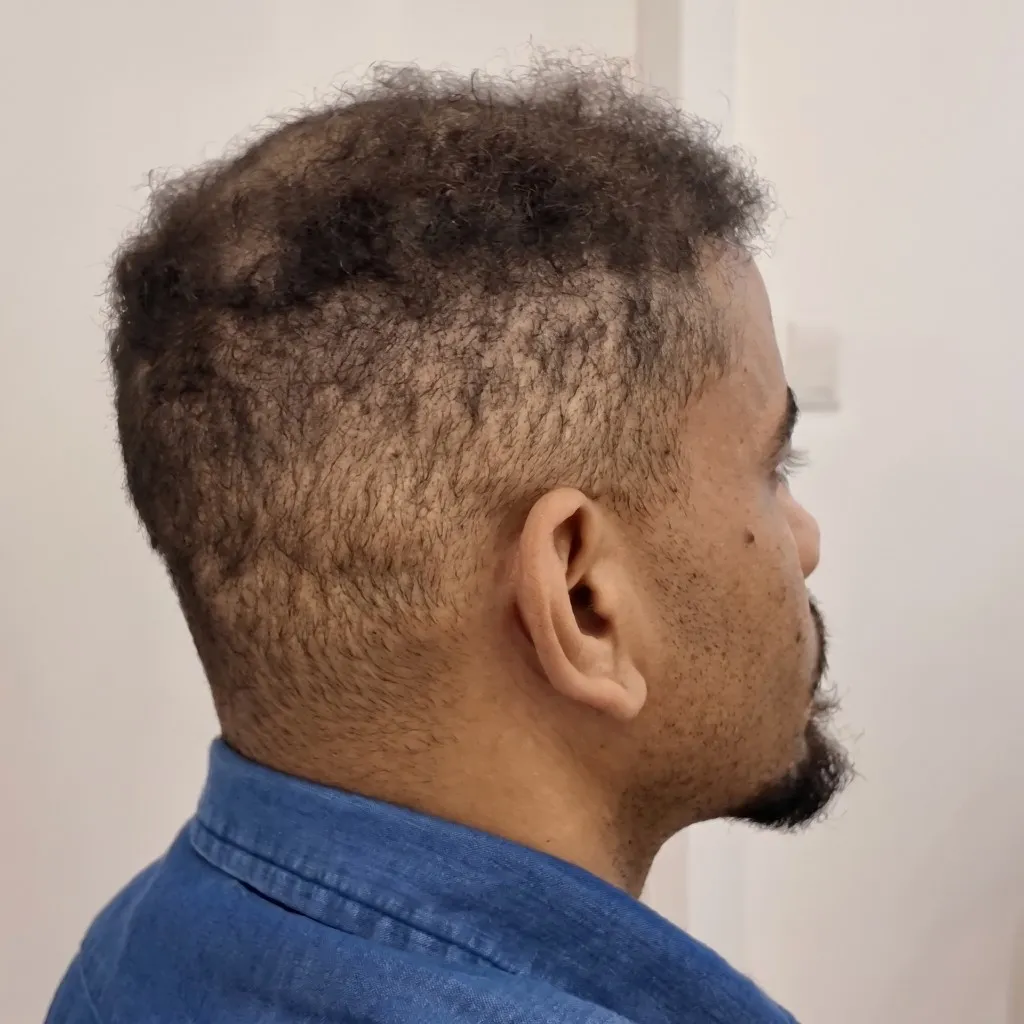 Perfil con cabello ralo antes del Sistema CTR y con cabello rizado y degradado después.